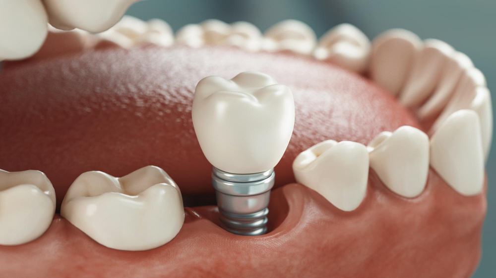 Dental Implants  Salt Lake City, UT